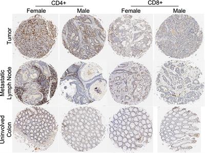 An analysis of sexual dimorphism in the tumor microenvironment of colorectal cancer